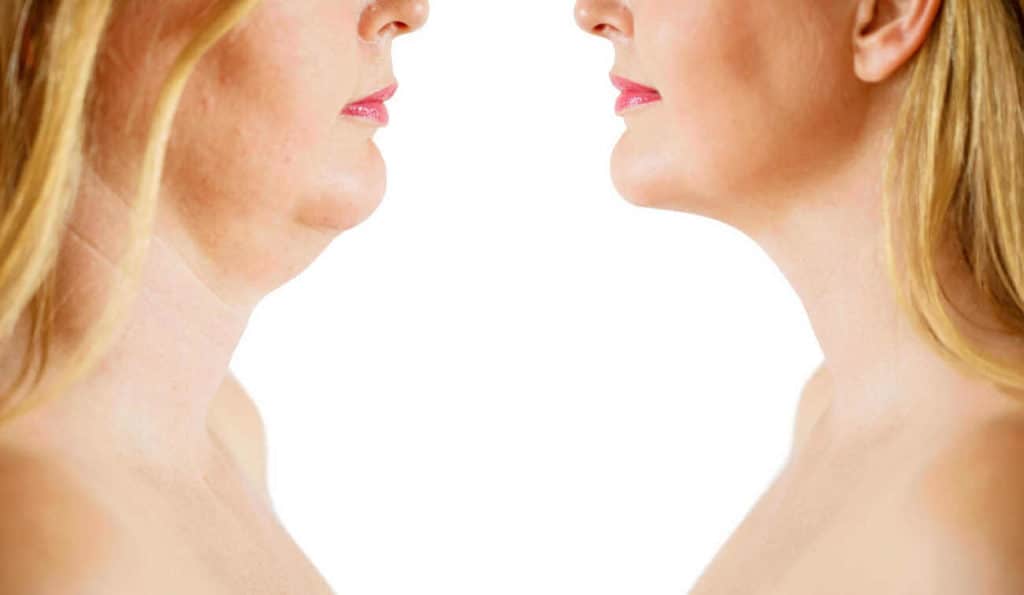 Double Chin treatment Swadlincote before and after results