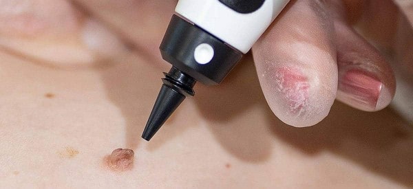After Skin Tag Removal Swadlincote