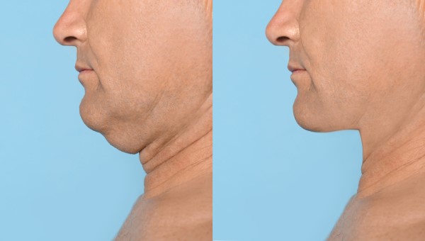 Which Non-Surgical Treatments Work Best for Jowls and Loose Skin Swadlincote?