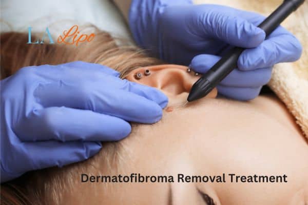 Dermatofibroma Removal Treatment Swadlincote