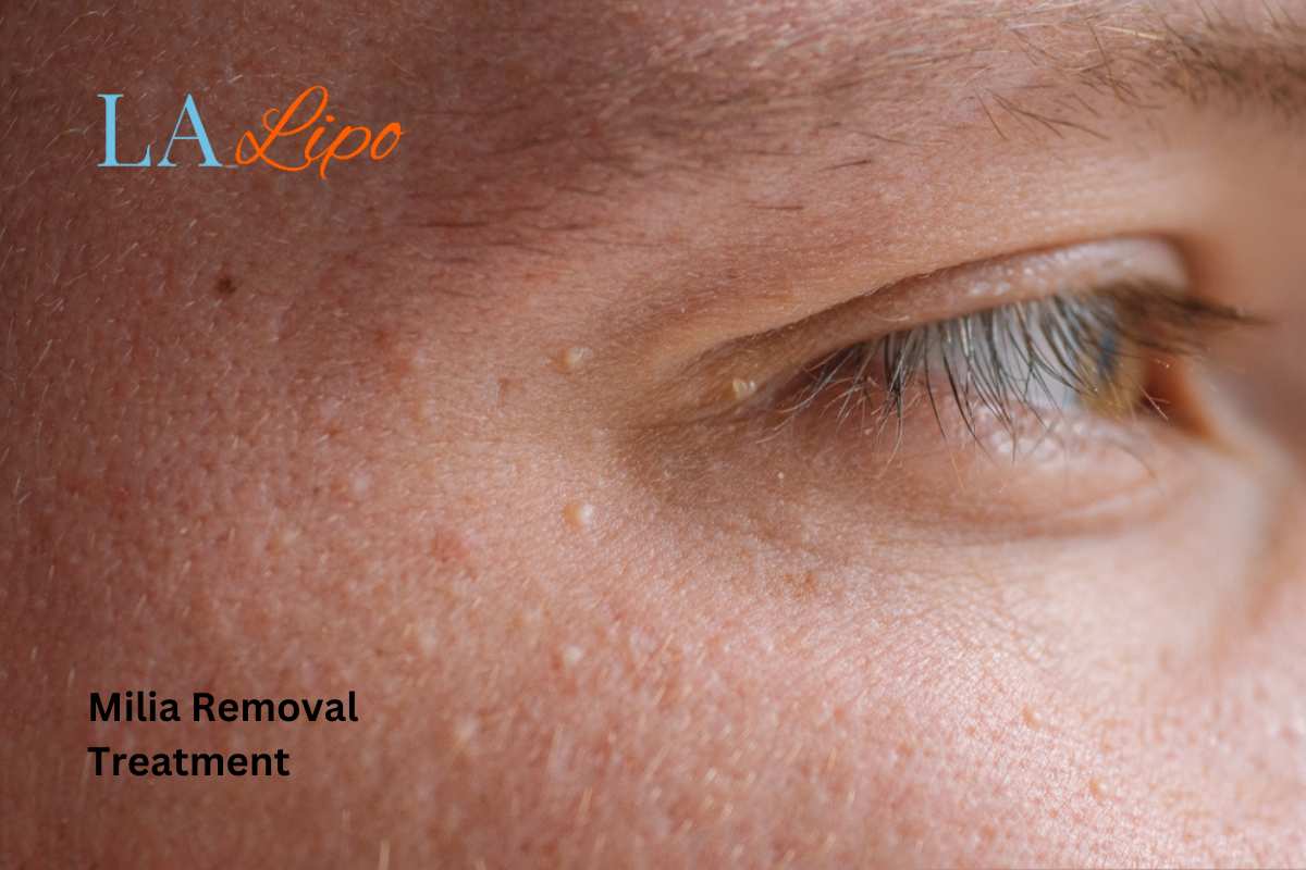 Cryopen Milia Removal: Is It the Easiest and Safest Option Swadlincote?