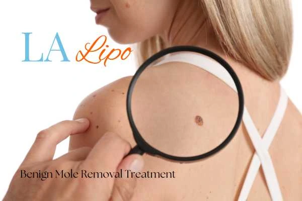 Woman having her inspection of blemish before mole removal Swadlincote