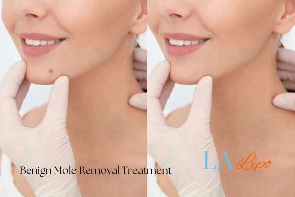 Before and after mole removal Swadlincote treatment
