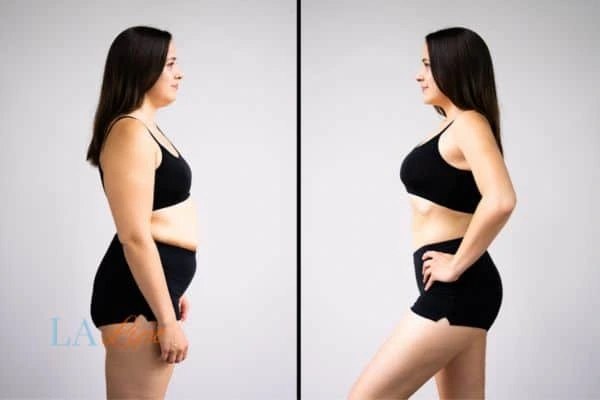 image of woman before and after results of LA-EMS Body Sculpting Swadlincote to help treat Diastasis recti
