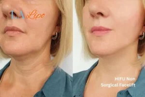 hi-fu for wrinkles Swadlincote before and after results