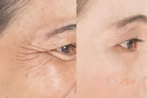Before and after results of woman - HI-fu wrinkles reduction treatment Swadlincote