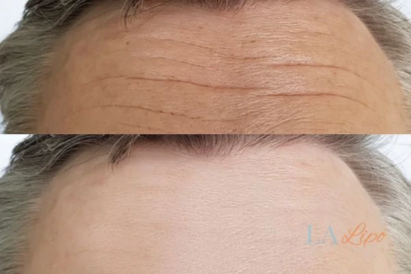 results of HIFU Swadlincote on mans forehead to help reduce lines and wrinkles