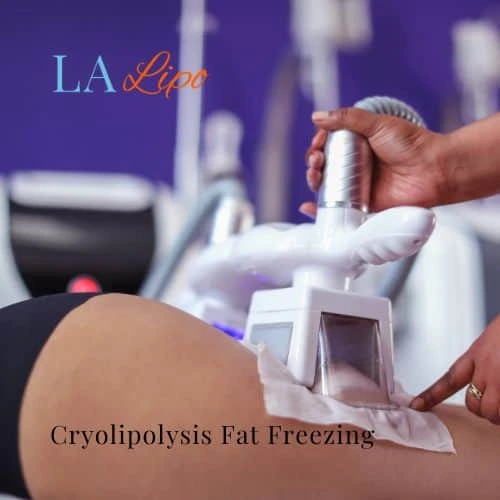 fat freezing - Cryolipolysis Swadlincote