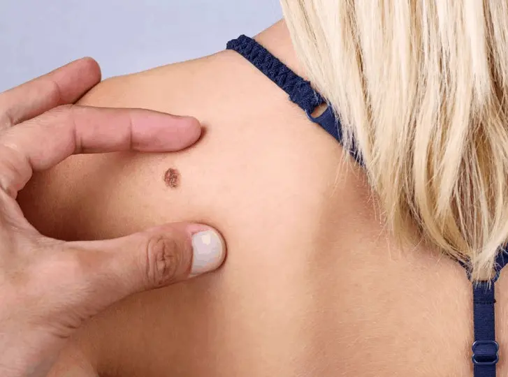 woman having mole removal Swadlincote consultation before treatment.
