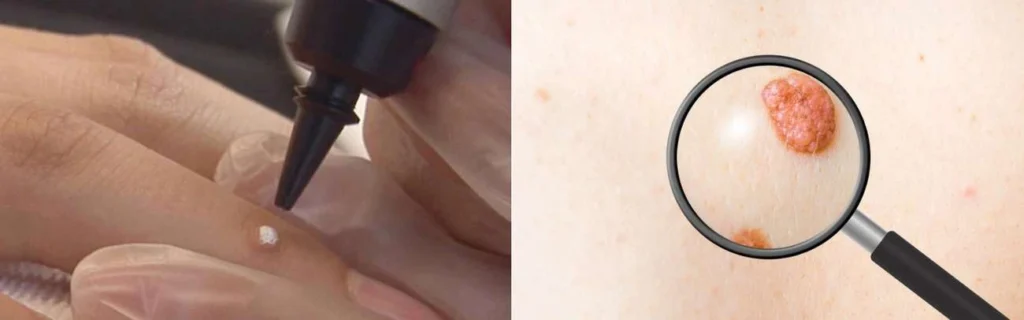 CryoPen practitioner Swadlincote assessing a benign mole before treatment