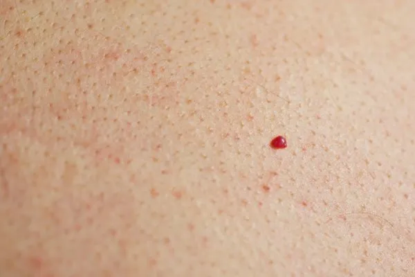 close up of a cherry angioma Swadlincote