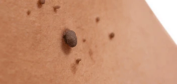 image of a skin tag Swadlincote