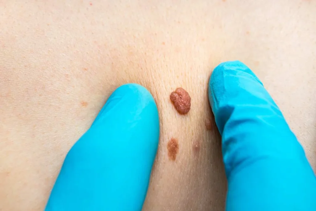Consultant examining a skin tag Swadlincote