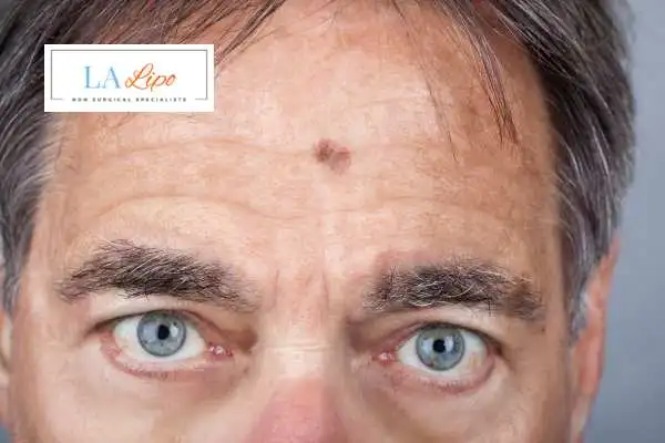 Solar Lentigo Removal Swadlincote image of man with mark on his forehead