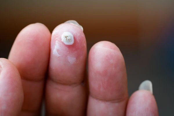 wart on person finger - cryotherapy to treat from LA LIPO Swadlincote
