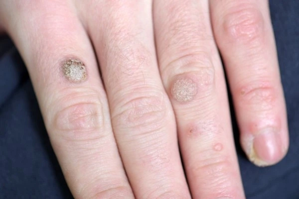 photo of warts on person hand - see wart removal Swadlincote from LA LIPO