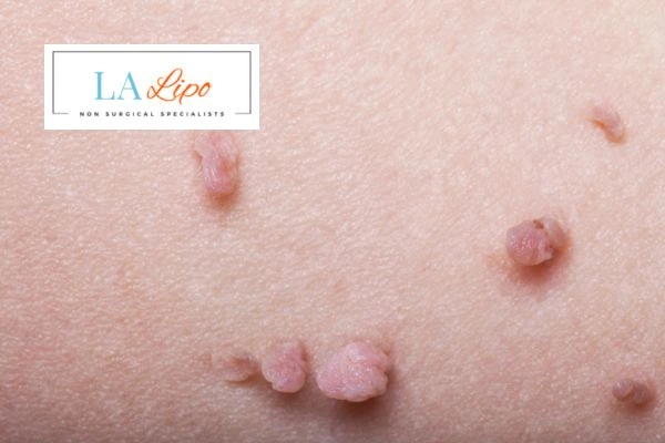 Does cryopen skin tag removal Swadlincote hurt? Find out now call our team today!