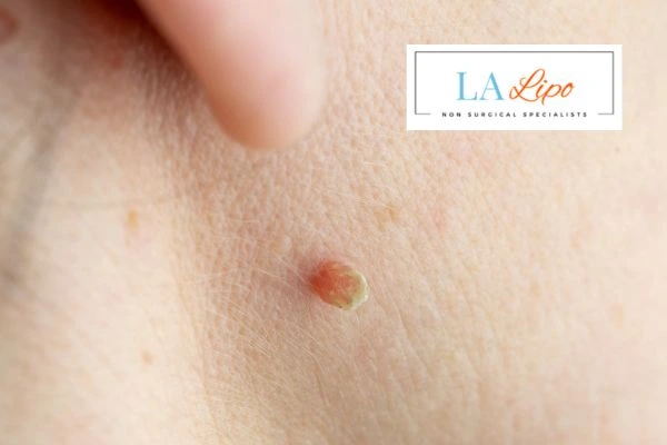 Book skin tag removal Swadlincote today speak to our team now!