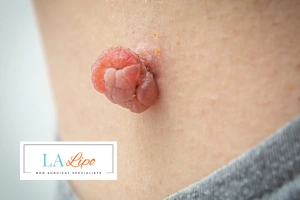 Interested in skin tag removal Swadlincote? Concerned about the pain? Find out more today!
