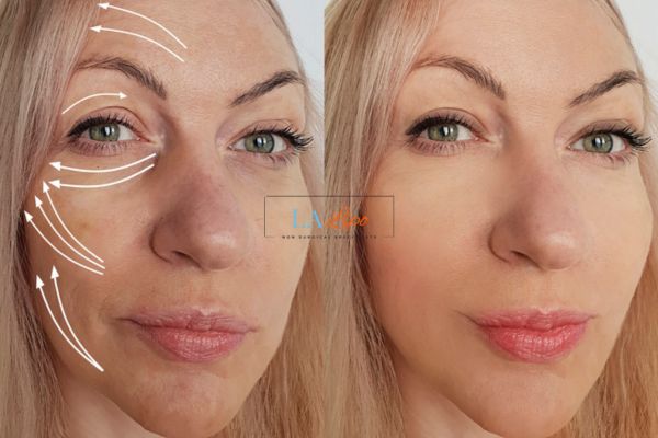 Morpheus 8 results Swadlincote face lift.