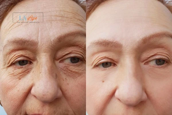 The powerful benefits of Morpheus8 Treatment Swadlincote - Call Our team today!