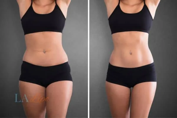before and after results of non-surgical treatment to help a woman's body image and mental health Swadlincote