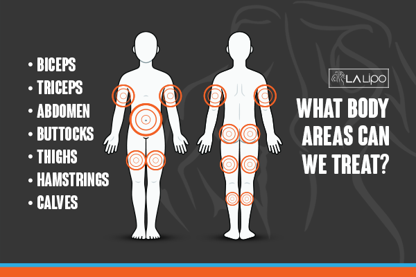 Diagram to show areas you can have LA-EMS Body Sculpting Treatment Swadlincote
