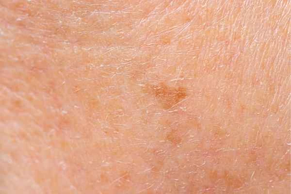 close up picture of age spots Swadlincote