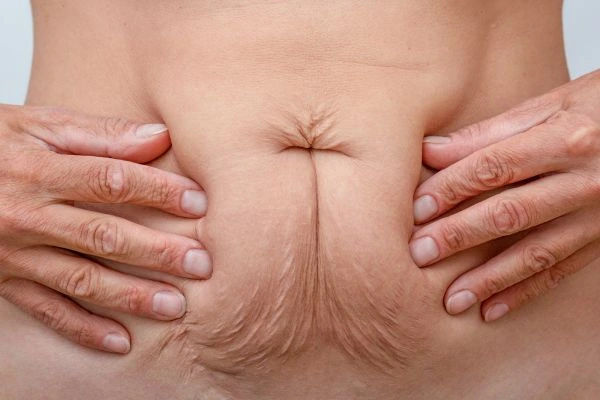 Image of a woman's stomach with loose skin - example of skin tightening Swadlincote options