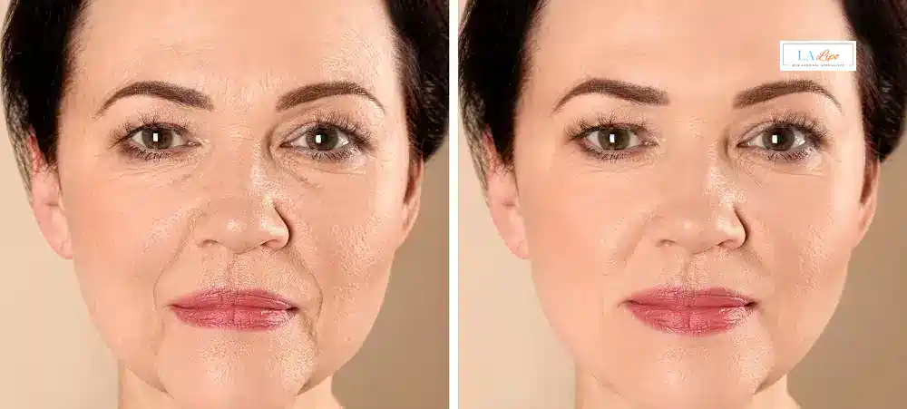 How Long Does It Take to See Results and How Long Do They Last Swadlincote?