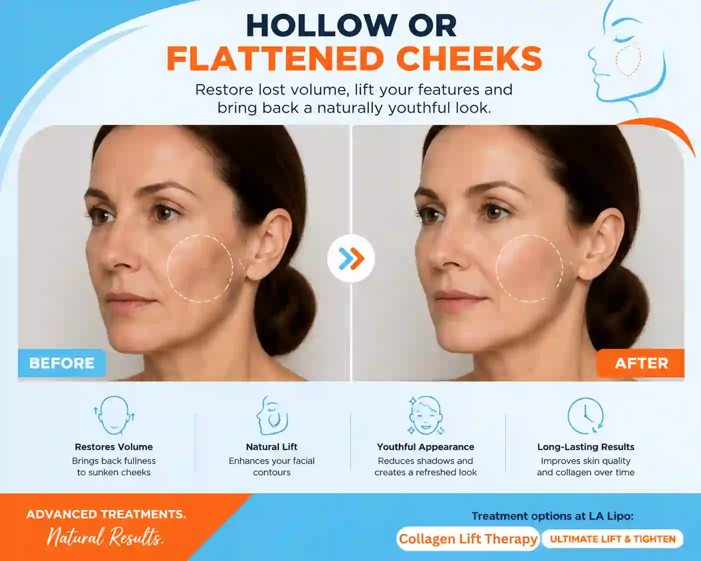 Sign #4: Hollow or Flattened Cheeks Swadlincote