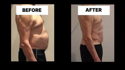 What Symptoms Can Diastasis Recti Cause in Men? Weak Core, Back Pain and Poor Posture Swadlincote